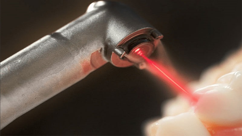 Стоматологический лазер